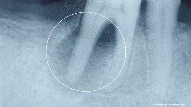 Tote Zähne verursachen Entzündungen im Kieferknochen