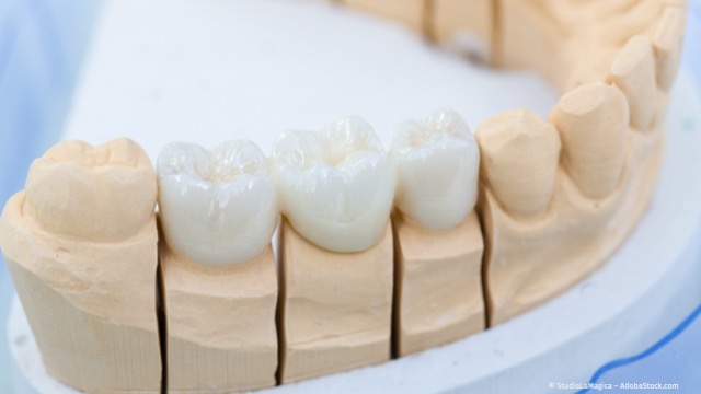 Ästhetische Zahnkronen und Zahnbrücken aus reiner Keramik