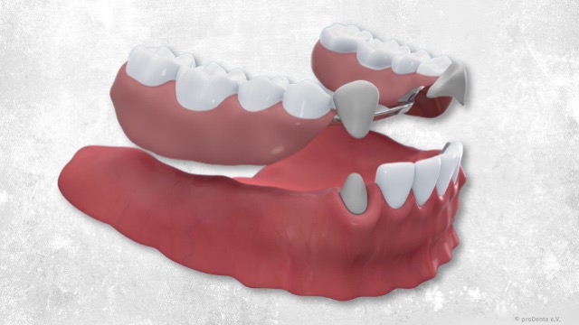 Herausnehmbarer Zahnersatz: Teilprothesen und Totalprothesen